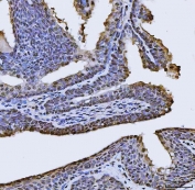 IHC staining of FFPE human prostate cancer tissue with FIP1L1 antibody. HIER: boil tissue sections in pH8 EDTA for 20 min and allow to cool before testing.