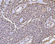 IHC staining of FFPE human breast cancer tissue with FIP1L1 antibody. HIER: boil tissue sections in pH8 EDTA for 20 min and allow to cool before testing.