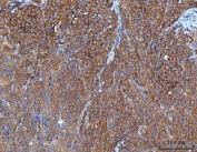 IHC staining of FFPE human cervical cancer tissue with Inosine-5'-monophosphate dehydrogenase 2 antibody. HIER: boil tissue sections in pH8 EDTA for 20 min and allow to cool before testing.