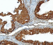 IHC staining of FFPE human ovarian cancer tissue with Inosine-5'-monophosphate dehydrogenase 2 antibody. HIER: boil tissue sections in pH8 EDTA for 20 min and allow to cool before testing.