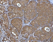 IHC staining of FFPE human breast cancer tissue with Inosine-5'-monophosphate dehydrogenase 2 antibody. HIER: boil tissue sections in pH8 EDTA for 20 min and allow to cool before testing.