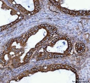 IHC staining of FFPE human ovarian cancer tissue with TOMM40 antibody. HIER: boil tissue sections in pH8 EDTA for 20 min and allow to cool before testing.