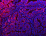 Immunofluorescent staining of FFPE human colon cancer tissue with TOMM40 antibody (red) and DAPI nuclear stain (blue). HIER: steam section in pH8 EDTA buffer for 20 min.