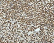 IHC staining of FFPE human liver cancer tissue with TOMM40 antibody. HIER: boil tissue sections in pH8 EDTA for 20 min and allow to cool before testing.