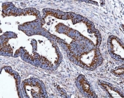IHC staining of FFPE human rectal cancer tissue with TOMM40 antibody. HIER: boil tissue sections in pH8 EDTA for 20 min and allow to cool before testing.