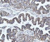 IHC staining of FFPE human lung adenocarcinoma tissue with TOMM40 antibody. HIER: boil tissue sections in pH8 EDTA for 20 min and allow to cool before testing.