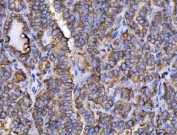 IHC staining of FFPE human thyroid cancer tissue with ERP29 antibody. HIER: boil tissue sections in pH8 EDTA for 20 min and allow to cool before testing.