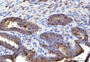 IHC staining of FFPE human prostate cancer tissue with ERP29 antibody. HIER: boil tissue sections in pH8 EDTA for 20 min and allow to cool before testing.