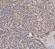 IHC staining of FFPE human breast cancer tissue with Malate dehydrogenase 2 antibody. HIER: boil tissue sections in pH8 EDTA for 20 min and allow to cool before testing.