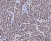 IHC staining of FFPE human squamous cell carcinoma tissue with Malate dehydrogenase 2 antibody. HIER: boil tissue sections in pH8 EDTA for 20 min and allow to cool before testing.