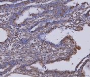 IHC staining of FFPE human cervical cancer tissue with Malate dehydrogenase 2 antibody. HIER: boil tissue sections in pH8 EDTA for 20 min and allow to cool before testing.