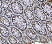 IHC staining of FFPE human colorectal adenocarcinoma tissue with hnRNP U antibody. HIER: boil tissue sections in pH8 EDTA for 20 min and allow to cool before testing.