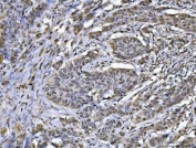 IHC staining of FFPE human esophageal squamous carcinoma tissue with hnRNP U antibody. HIER: boil tissue sections in pH8 EDTA for 20 min and allow to cool before testing.
