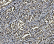 IHC staining of FFPE human gastric carcinoma tissue with hnRNP U antibody. HIER: boil tissue sections in pH8 EDTA for 20 min and allow to cool before testing.