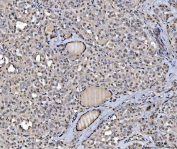IHC staining of FFPE human thyroid cancer tissue with hnRNP U antibody. HIER: boil tissue sections in pH8 EDTA for 20 min and allow to cool before testing.