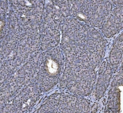 IHC staining of FFPE human breast cancer tissue with hnRNP U antibody. HIER: boil tissue sections in pH8 EDTA for 20 min and allow to cool before testing.
