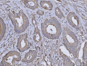 IHC staining of FFPE human colorectal adenocarcinoma tissue with ARL1 antibody. HIER: boil tissue sections in pH8 EDTA for 20 min and allow to cool before testing.