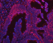 Immunofluorescent staining of FFPE human colon cancer tissue with ARL1 antibody (red) and DAPI nuclear stain (blue). HIER: steam section in pH6 citrate buffer for 20 min.