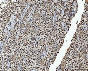 IHC staining of FFPE human testicular cancer tissue with HNRPL antibody. HIER: boil tissue sections in pH8 EDTA for 20 min and allow to cool before testing.