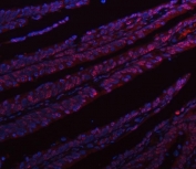Immunofluorescent staining of FFPE human colorectal adenocarcinoma tissue with HNRPL antibody (red) and DAPI nuclear stain (blue). HIER: steam section in pH8 EDTA buffer for 20 min.