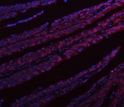 Immunofluorescent staining of FFPE human colorectal adenocarcinoma tissue with HNRPL antibody (red) and DAPI nuclear stain (blue). HIER: steam section in pH8 EDTA buffer for 20 min.