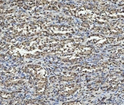 IHC staining of FFPE human gastric carcinoma tissue with HNRPL antibody. HIER: boil tissue sections in pH8 EDTA for 20 min and allow to cool before testing.