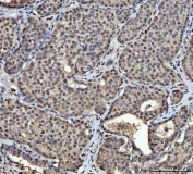 IHC staining of FFPE human breast cancer tissue with HNRPL antibody. HIER: boil tissue sections in pH8 EDTA for 20 min and allow to cool before testing.
