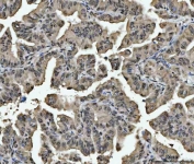 IHC staining of FFPE human lung adenocarcinoma tissue with HNRPL antibody. HIER: boil tissue sections in pH8 EDTA for 20 min and allow to cool before testing.