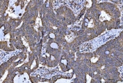 IHC staining of FFPE human colorectal adenocarcinoma tissue with NDUFS5 antibody. HIER: boil tissue sections in pH8 EDTA for 20 min and allow to cool before testing.
