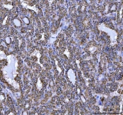 IHC staining of FFPE human thyroid cancer tissue with NDUFS5 antibody. HIER: boil tissue sections in pH8 EDTA for 20 min and allow to cool before testing.
