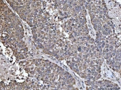 IHC staining of FFPE human liver cancer tissue with NDUFS5 antibody. HIER: boil tissue sections in pH8 EDTA for 20 min and allow to cool before testing.