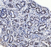 IHC staining of FFPE human cervical cancer tissue with CFIm68 antibody. HIER: boil tissue sections in pH8 EDTA for 20 min and allow to cool before testing.