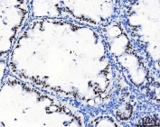 IHC staining of FFPE human ovarian cancer tissue with CFIm68 antibody. HIER: boil tissue sections in pH8 EDTA for 20 min and allow to cool before testing.