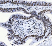 IHC staining of FFPE human colorectal adenocarcinoma tissue with CFIm68 antibody. HIER: boil tissue sections in pH8 EDTA for 20 min and allow to cool before testing.