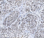 IHC staining of FFPE human squamous cell carcinoma tissue with CFIm68 antibody. HIER: boil tissue sections in pH8 EDTA for 20 min and allow to cool before testing.