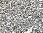 IHC staining of FFPE human testicular carcinoma tissue with ARL13B antibody. HIER: boil tissue sections in pH8 EDTA for 20 min and allow to cool before testing.