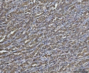 IHC staining of FFPE human gastric carcinoma tissue with ARL13B antibody. HIER: boil tissue sections in pH8 EDTA for 20 min and allow to cool before testing.
