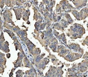 IHC staining of FFPE human colorectal adenocarcinoma tissue with ARL13B antibody. HIER: boil tissue sections in pH8 EDTA for 20 min and allow to cool before testing.