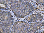 IHC staining of FFPE human breast cancer tissue with ARL13B antibody. HIER: boil tissue sections in pH8 EDTA for 20 min and allow to cool before testing.
