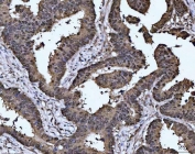 IHC staining of FFPE human rectal cancer tissue with MAT2A antibody. HIER: boil tissue sections in pH8 EDTA for 20 min and allow to cool before testing.