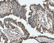 IHC staining of FFPE human lung adenocarcinoma tissue with MAT2A antibody. HIER: boil tissue sections in pH8 EDTA for 20 min and allow to cool before testing.