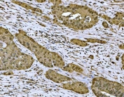 IHC staining of FFPE human appendiceal adenocarcinoma tissue with MAT2A antibody. HIER: boil tissue sections in pH8 EDTA for 20 min and allow to cool before testing.