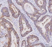 IHC staining of FFPE human colorectal adenocarcinoma tissue with CLDN3 antibody. HIER: boil tissue sections in pH8 EDTA for 20 min and allow to cool before testing.