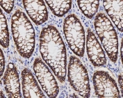 IHC staining of FFPE human colorectal adenocarcinoma tissue with CLDN3 antibody. HIER: boil tissue sections in pH8 EDTA for 20 min and allow to cool before testing.