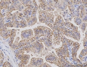 IHC staining of FFPE human lung adenocarcinoma tissue with CLDN3 antibody. HIER: boil tissue sections in pH8 EDTA for 20 min and allow to cool before testing.