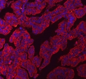 Immunofluorescent staining of FFPE human lung adenocarcinoma tissue with CLDN3 antibody (red) and DAPI nuclear stain (blue). HIER: steam section in pH6 citrate buffer for 20 min.