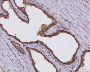 IHC staining of FFPE human prostate cancer tissue with CLASP1 antibody. HIER: boil tissue sections in pH8 EDTA for 20 min and allow to cool before testing.