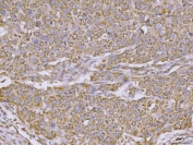 IHC staining of FFPE human esophageal squamous carcinoma tissue with CLASP1 antibody. HIER: boil tissue sections in pH8 EDTA for 20 min and allow to cool before testing.