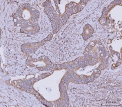 IHC staining of FFPE human colorectal adenocarcinoma tissue with CLASP1 antibody. HIER: boil tissue sections in pH8 EDTA for 20 min and allow to cool before testing.