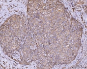 IHC staining of FFPE squamous cell carcinoma of human cervix tissue with CLASP1 antibody. HIER: boil tissue sections in pH8 EDTA for 20 min and allow to cool before testing.